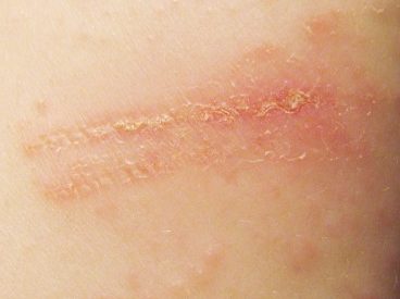 How I cured my Fitbit rash