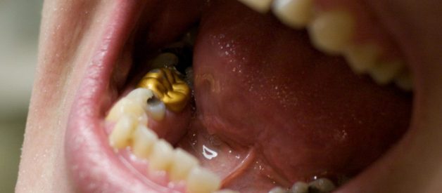 WHAT IS THE VALUE OF YOUR DENTAL GOLD?